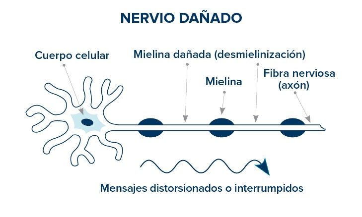 nervio dañado
